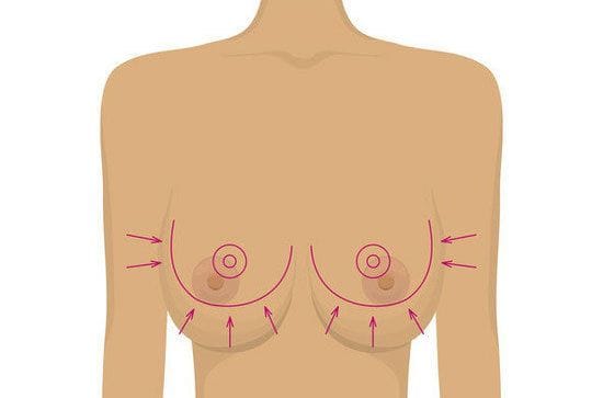 What size will I be after breast reduction?